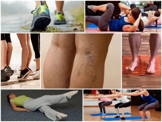 exercise for varicose veins