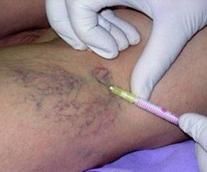 injection of varicose veins