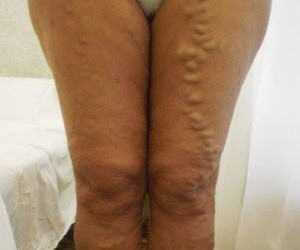 photos of varicose veins