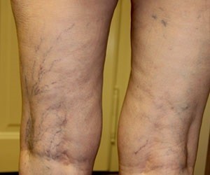 varicose expansion of veins