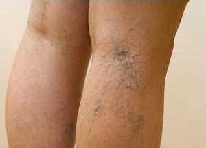 varicose veins-legs