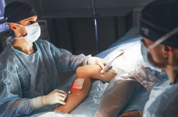 surgery for varicose veins with a laser