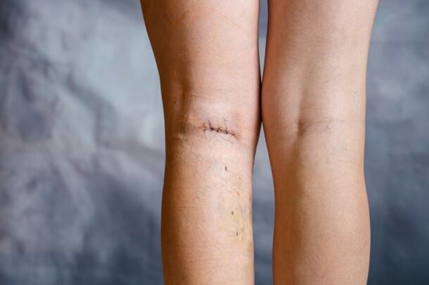 suture on the leg after surgery for varicose veins