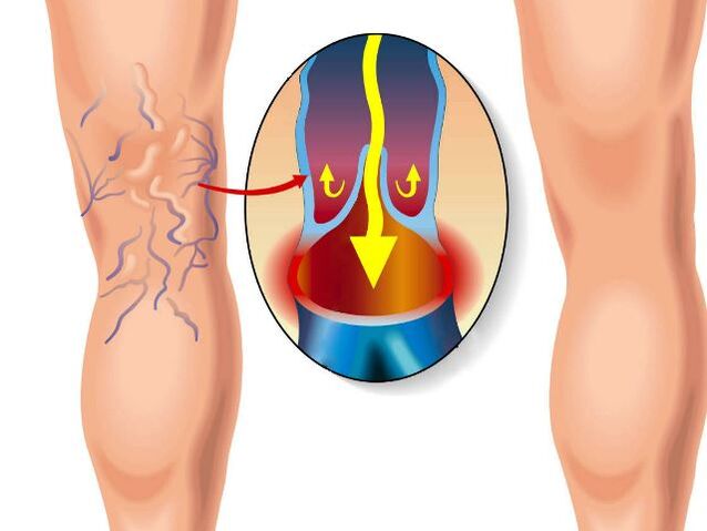 a healthy leg and varicose veins in the leg