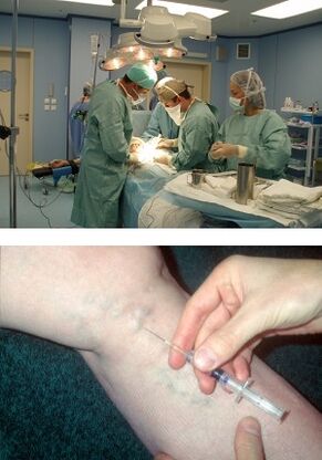 sclerotherapy for the treatment of varicose veins