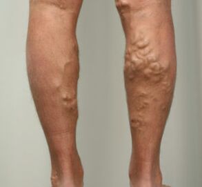 nodes on the legs with varicose veins