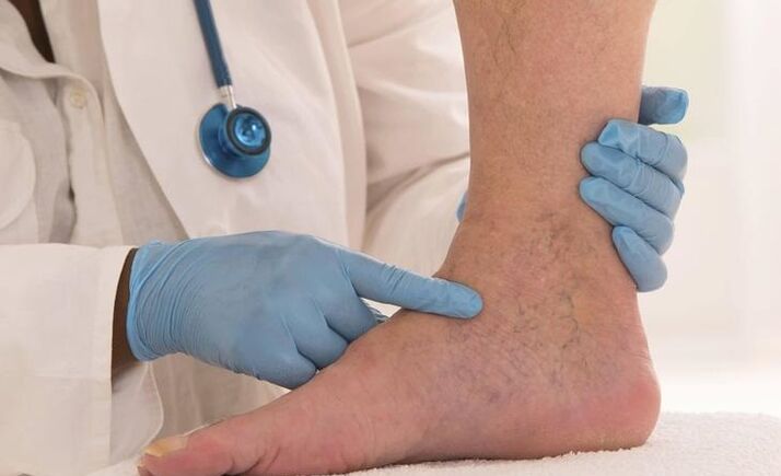 the doctor examines the leg with varicose veins