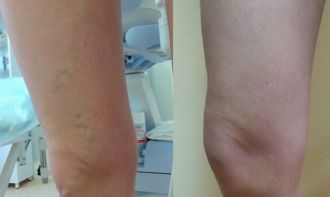 leg before and after treatment of reticular varicose veins