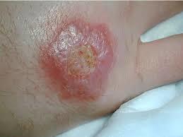 skin ulcers,