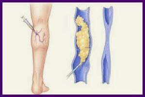 Sclerotherapy is a popular method of getting rid of varicose veins on the legs