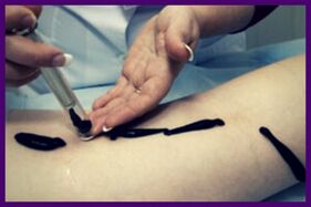 The procedure for treating varicose veins with leeches (hirudotherapy)