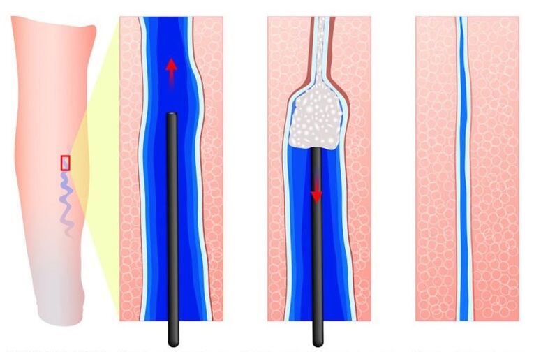 sclerotherapy for varicose veins of the labia