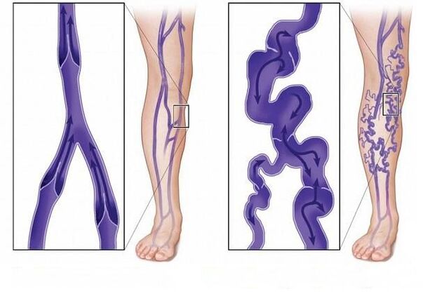 normal vein valves and valves with varicose veins