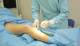 how is the operation performed for varicose veins