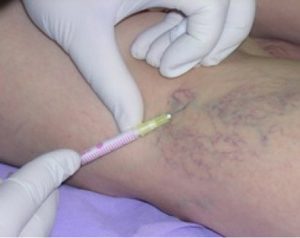 pain with varicose veins treatment fluids