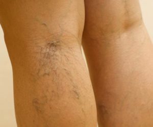 pain with varicose veins treatment