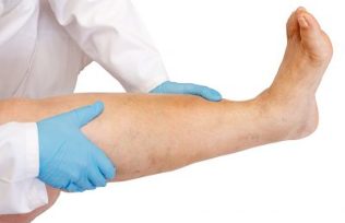 treatment of varicose veins
