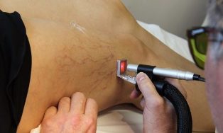 treatment of varicose veins laser
