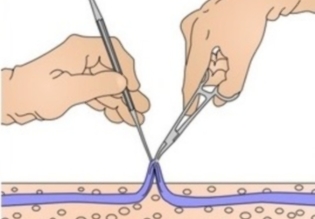varicose veins surgical treatment