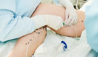methods of treating varicose veins on the legs in women