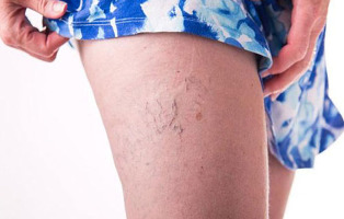 Varicose veins on the leg