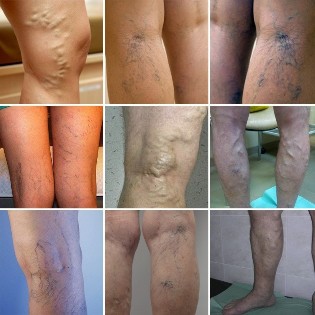 Pictures of varicose veins of the lower extremities
